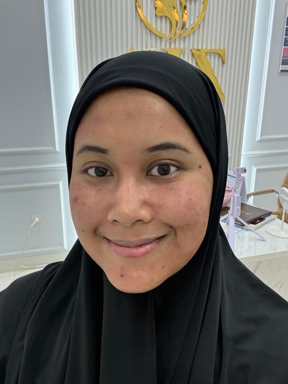 Sebelum - Laser Co2 + Skinbooster Rejuran + Skinbooster NCTF